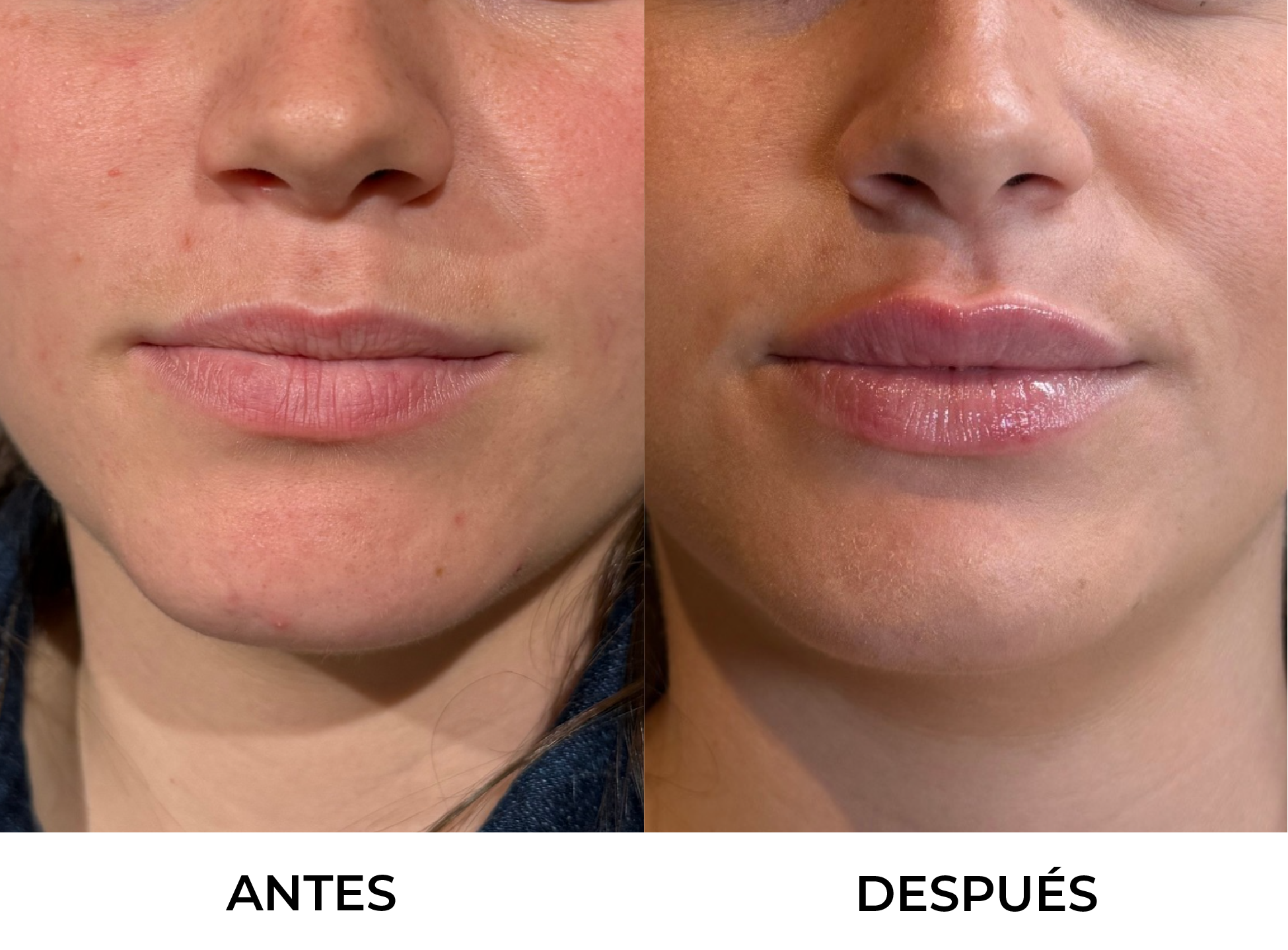 Aumento / Hidratación de Labios