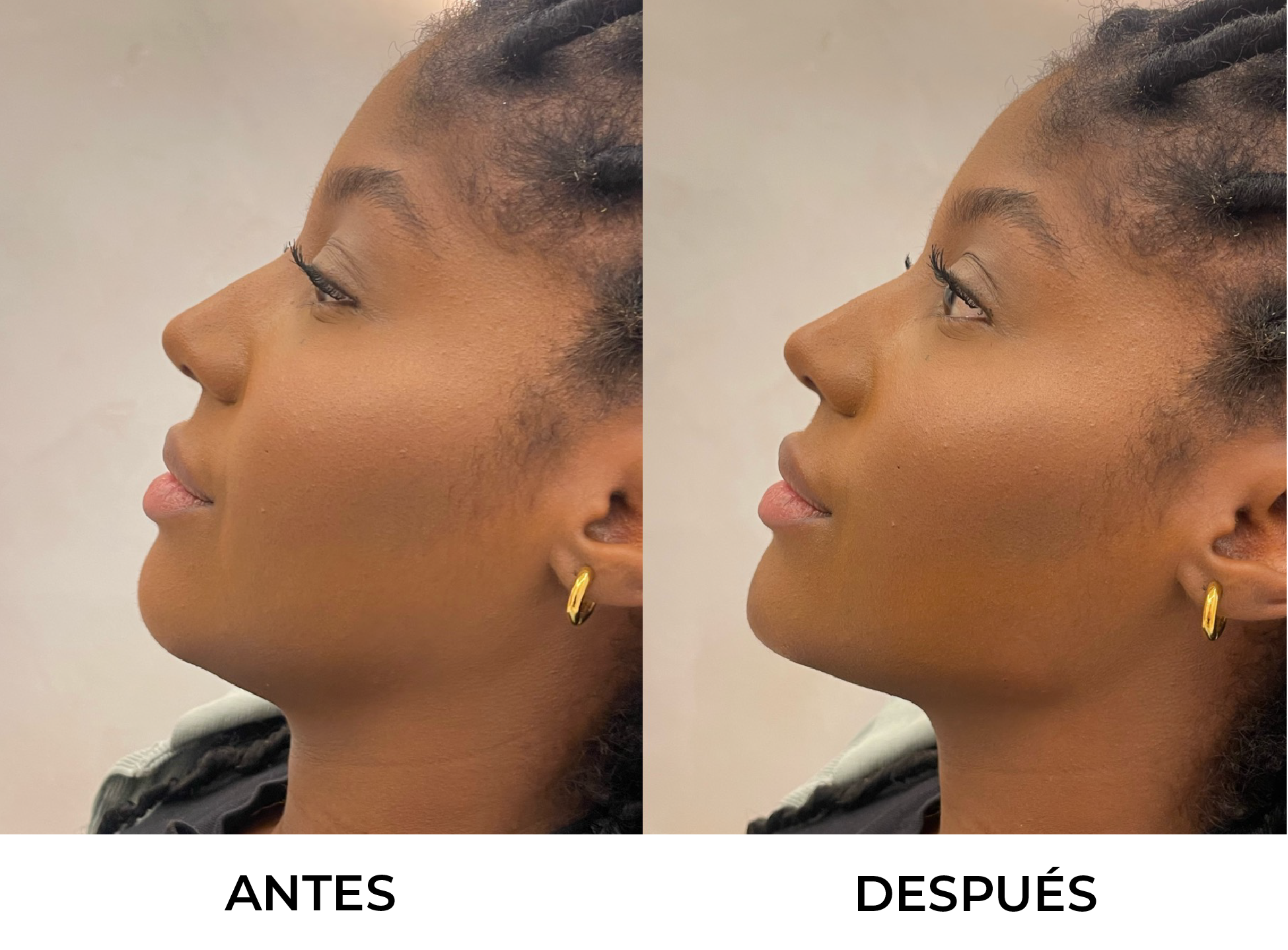 Marcación Ángulo Mandibular