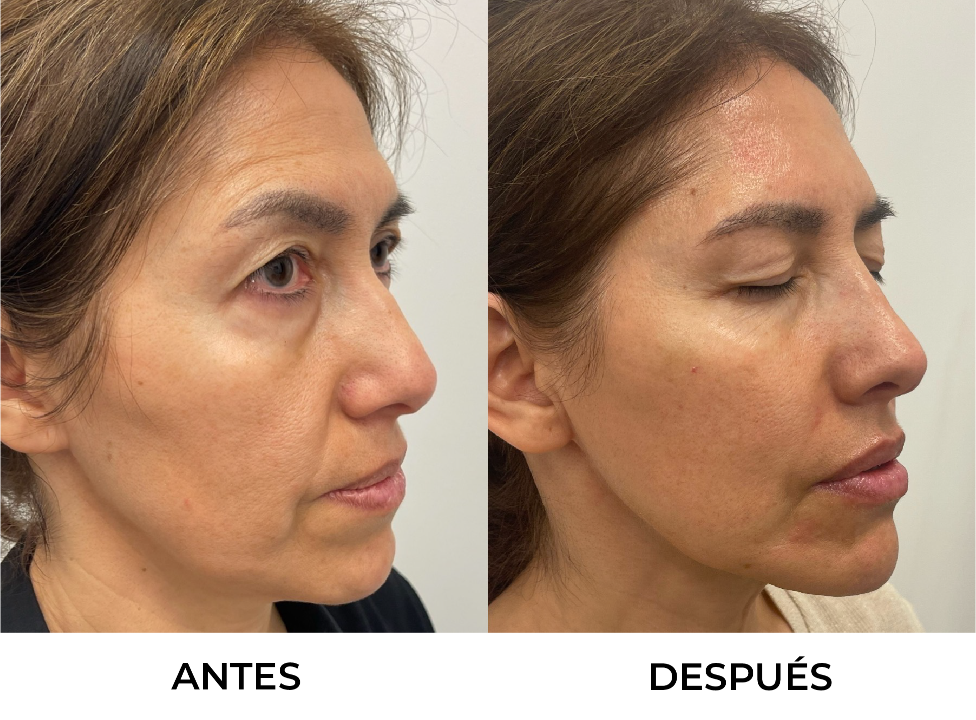 Antes y Después 3