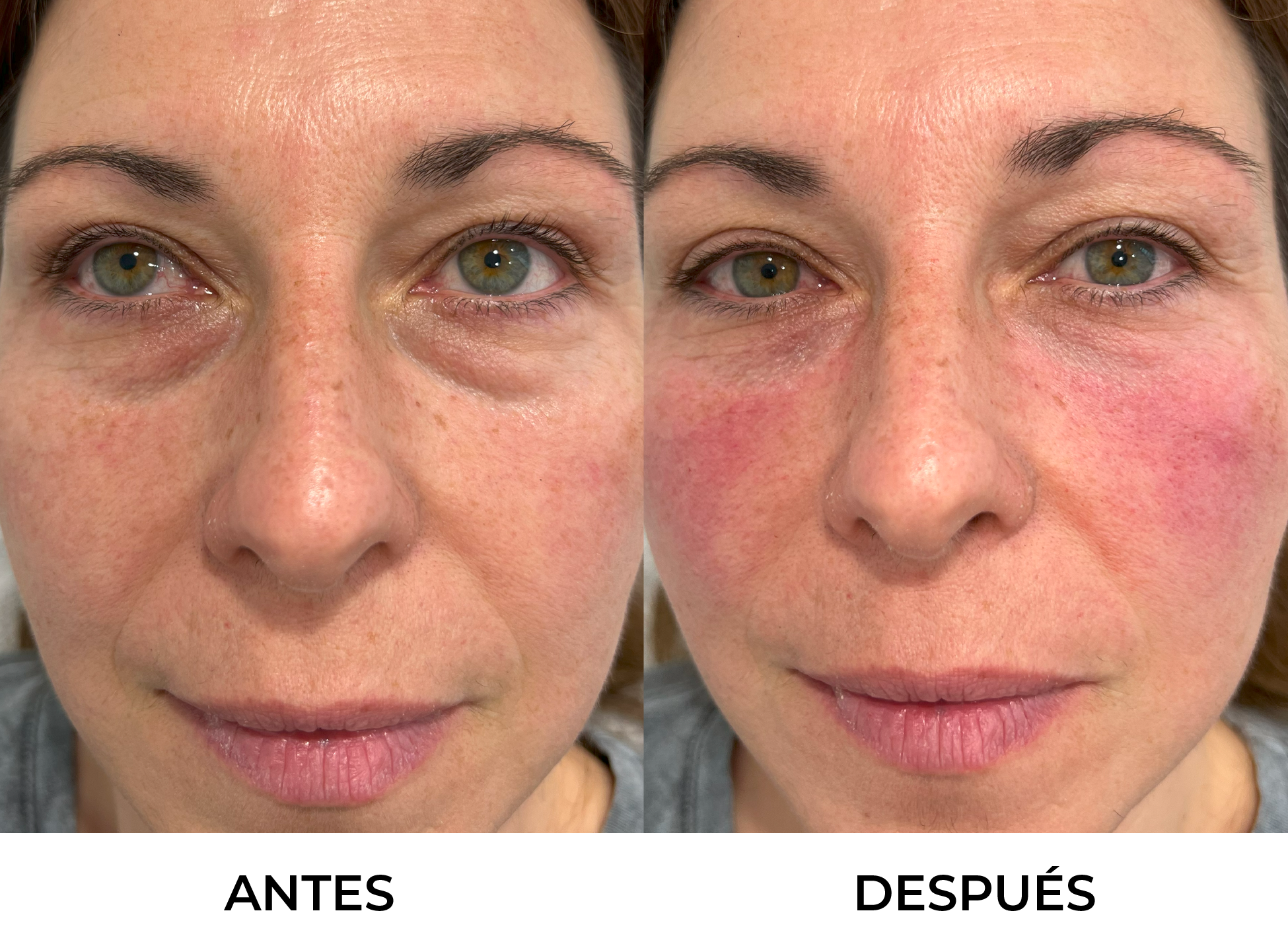 Antes y Después 5