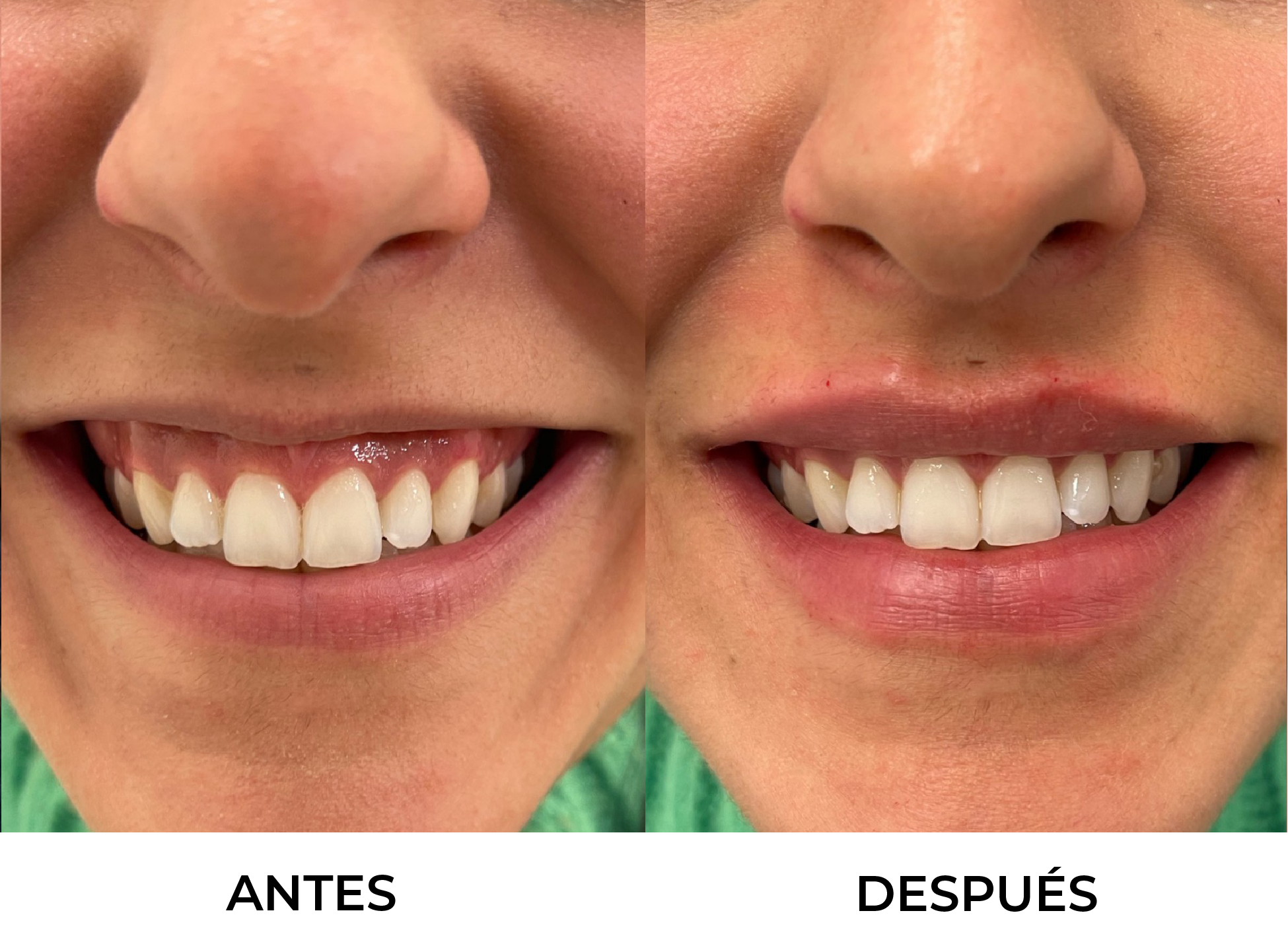 Tratamiento Sonrisa Gingival