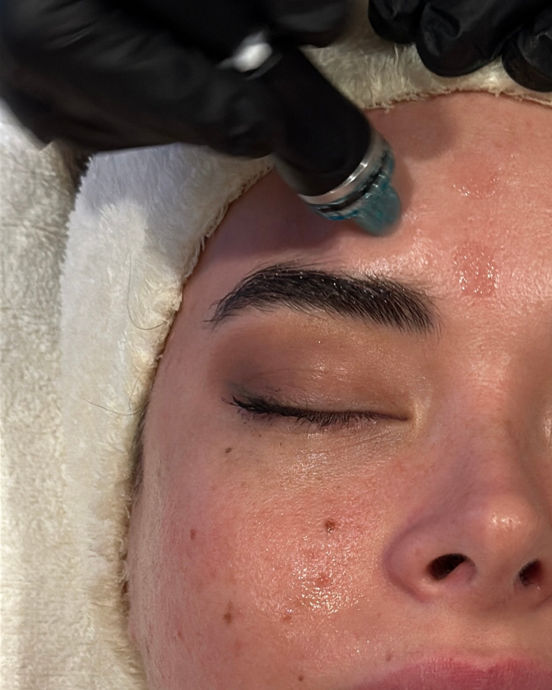 Microneedling o Dermapen