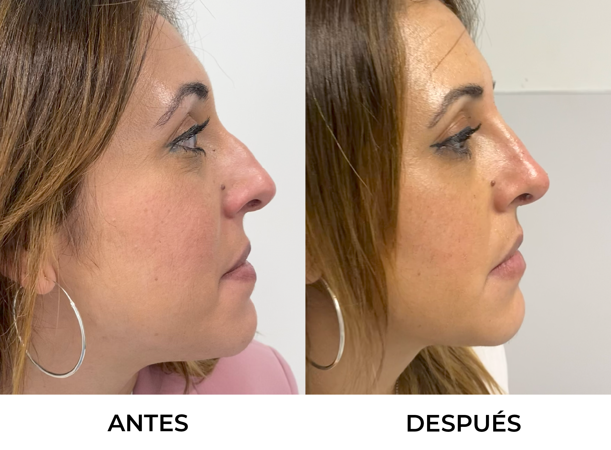 Antes y Después 15