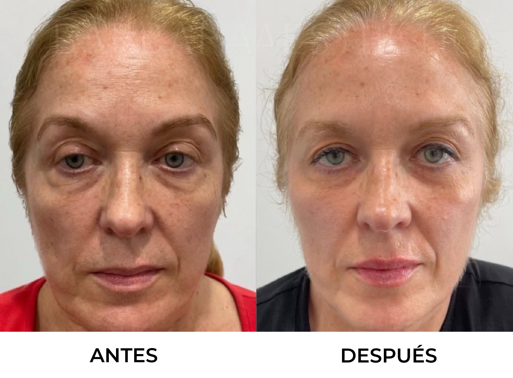 Antes y Después 4