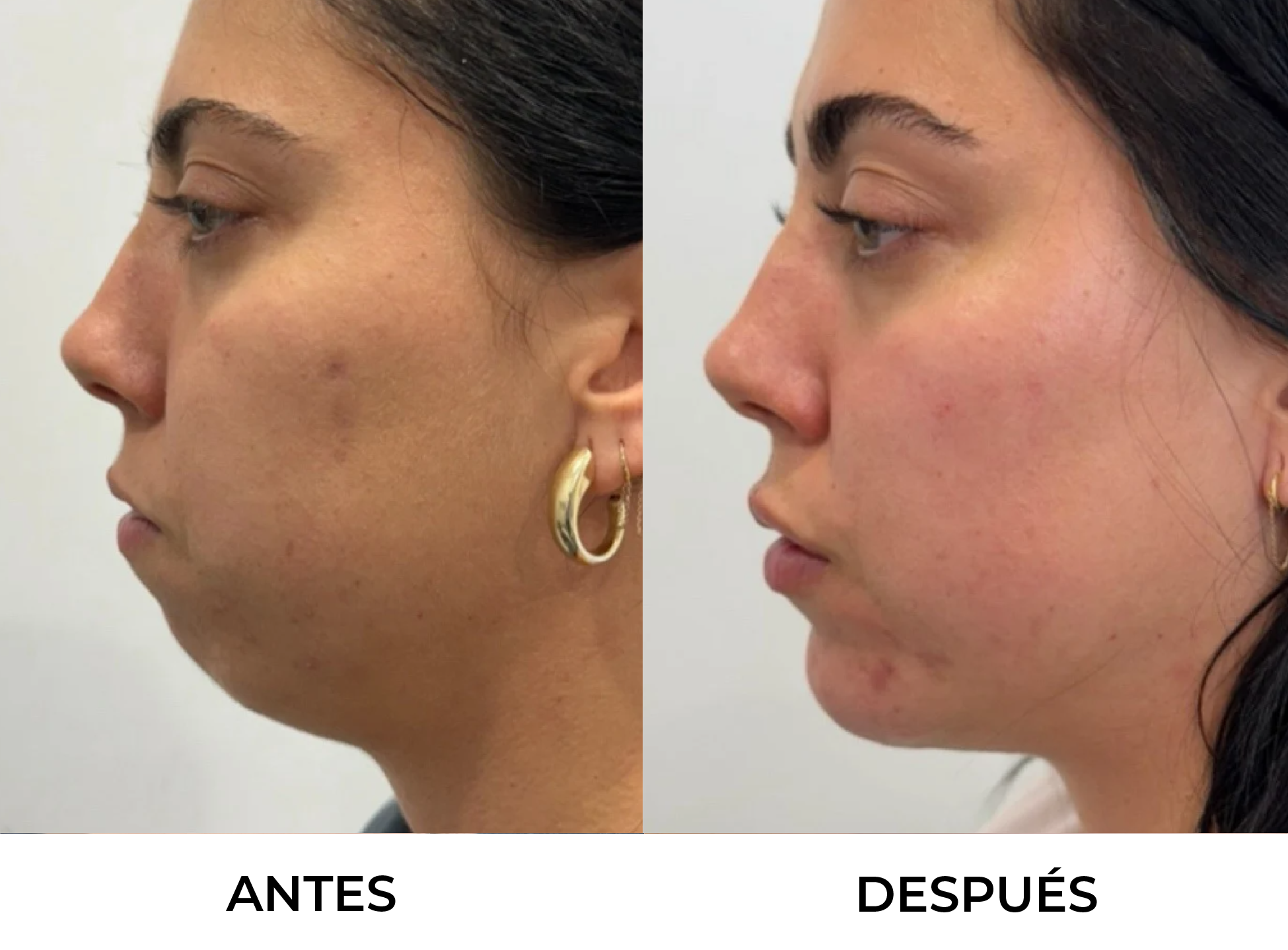 Proyección del Mentón