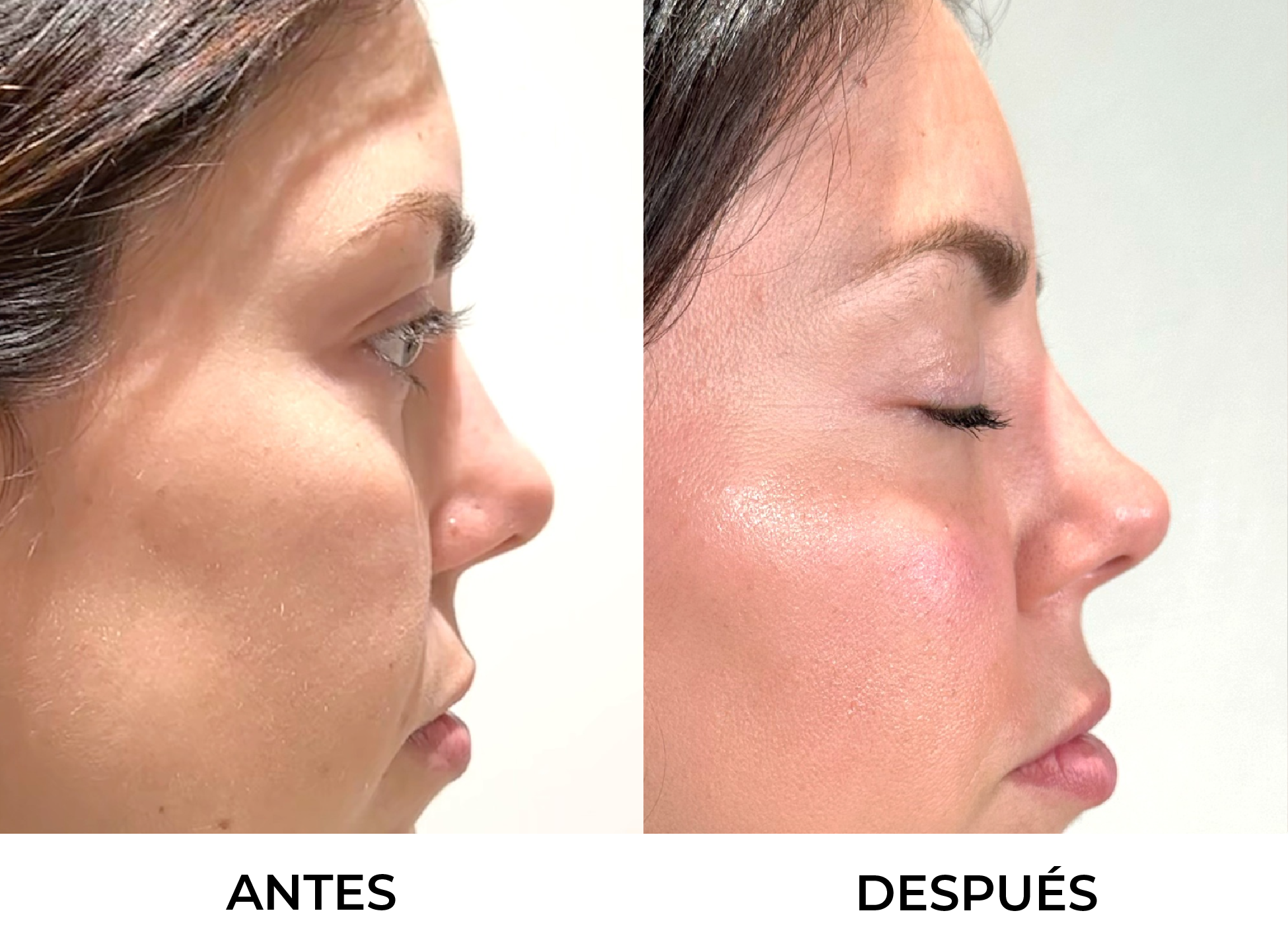 Reposición de Pómulo