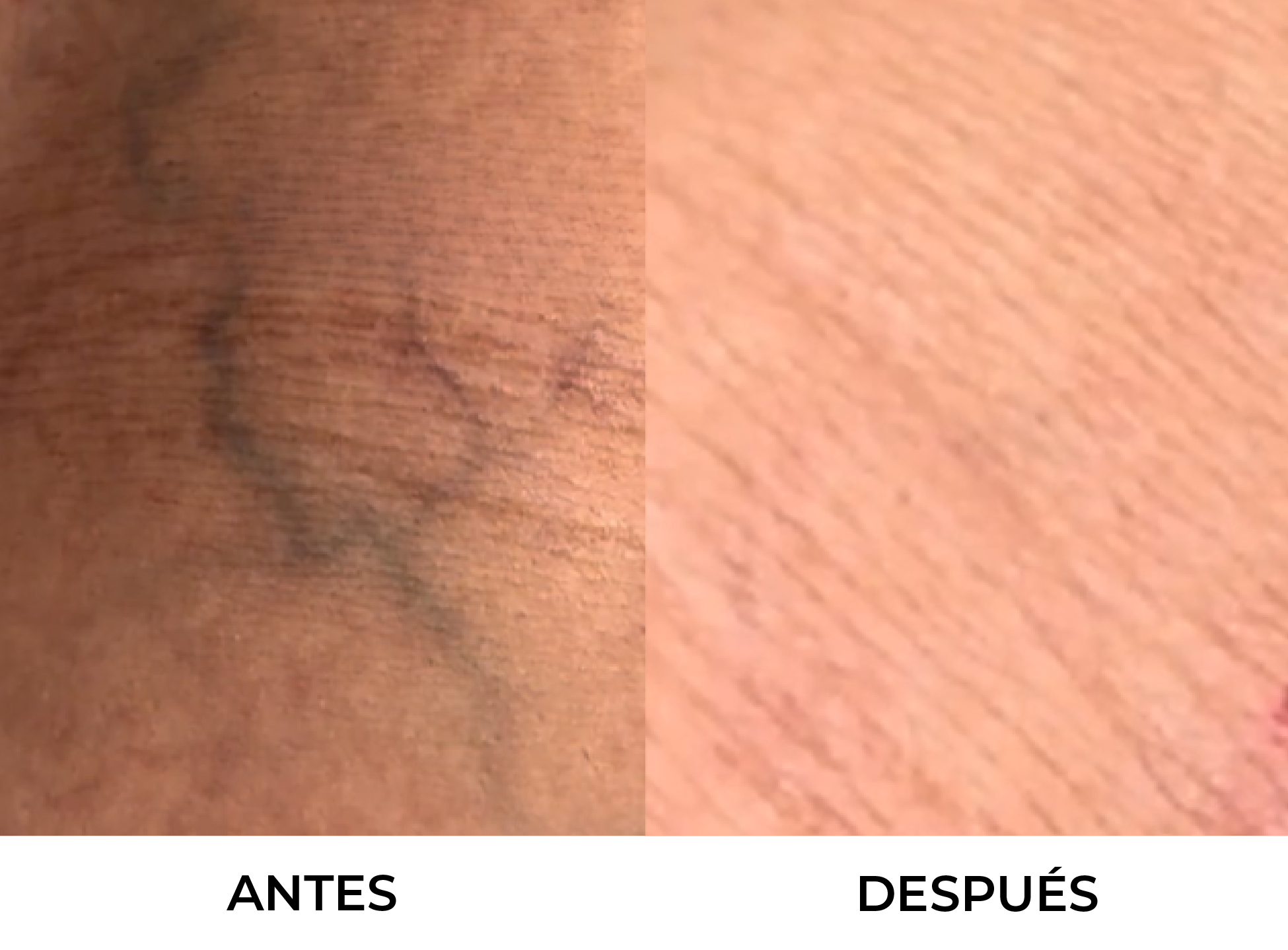 VARICES Y ARAÑAS VASCULARES