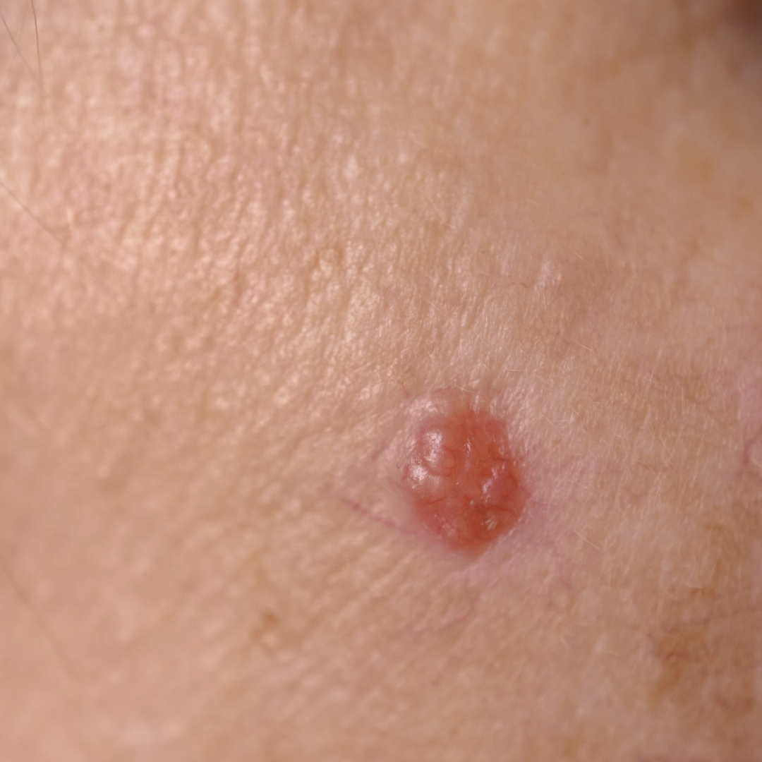 Extirpación de Lesiones Cutáneas