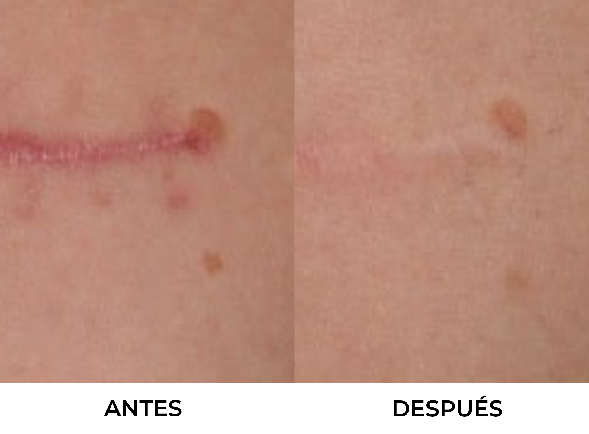 Tratamiento de Cicatrices